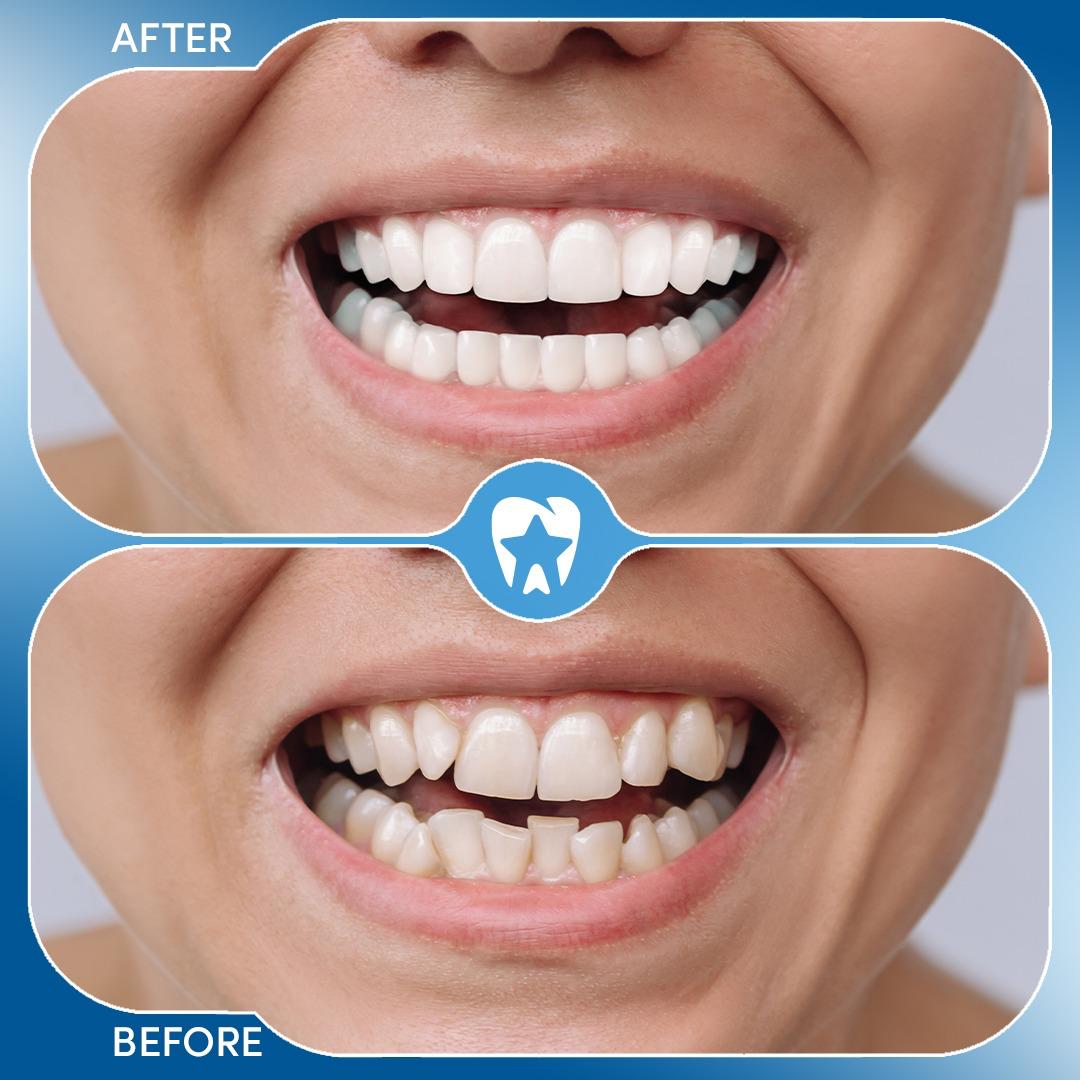 All on 6 (6 Implants + 12 Crowns) before and after